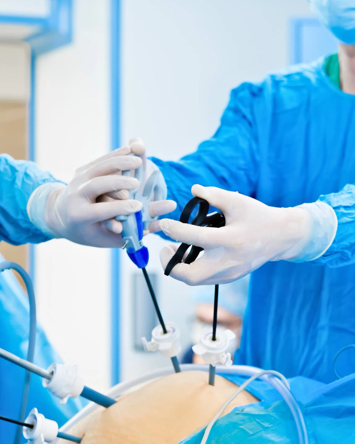 Apendicectomía Laparoscópica