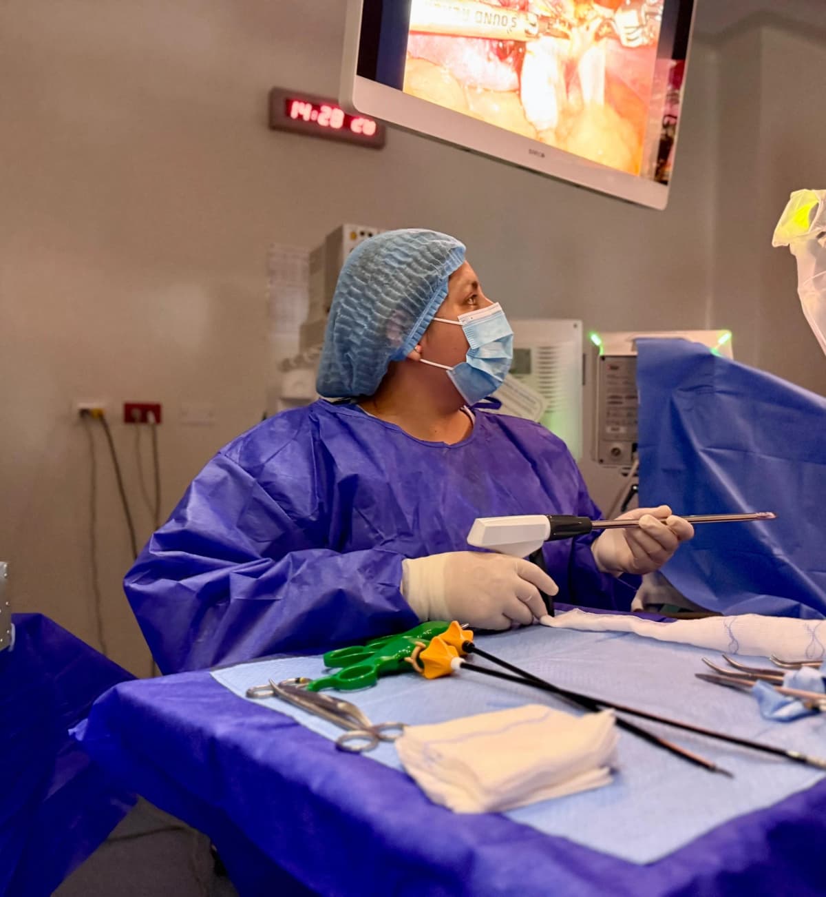 Apendicectomía Laparoscópica con armónico